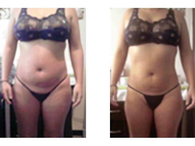 lipusuccion sin cirugia ultracavitacion lipusuccion sin cirugia ultracavitacion